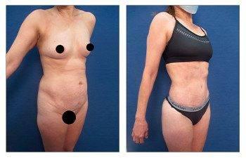 High Definition Tummy Tuck High Definition Tummy Tuck