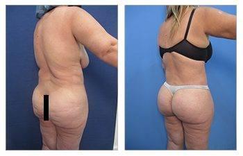 Butt Implants VS BBL With Fat Transfer Butt Implants VS BBL With Fat Transfer