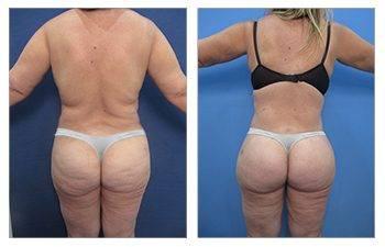Lats vs. Hips Lats vs. Hips