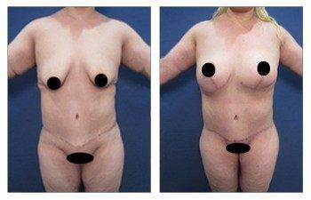 How Body Lift incision Healing is Optimized
