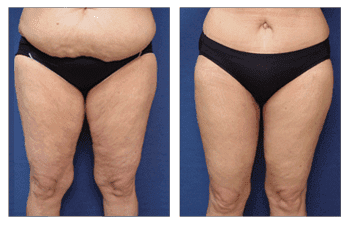 How Can Lipedema Fat Be Managed? How Can Lipedema Fat Be Managed?