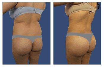 HD Liposuction + Fat Transfer — #SS131 HD Liposuction + Fat Transfer — #SS131