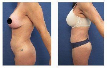 abdominal liposuction left view abdominal liposuction left view