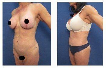 abdominal liposuction front left view abdominal liposuction front left view