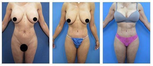 How Do Results Improve with Time After High Definition Body Contouring How Do Results Improve with Time After High Definition Body Contouring