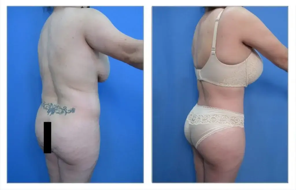 A woman in underwear before and after surgery.