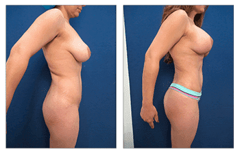 Breast Augmentation Surgery