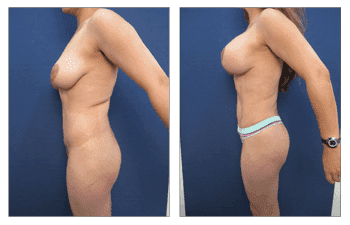 A woman's breast before and after surgery for breast herniation.