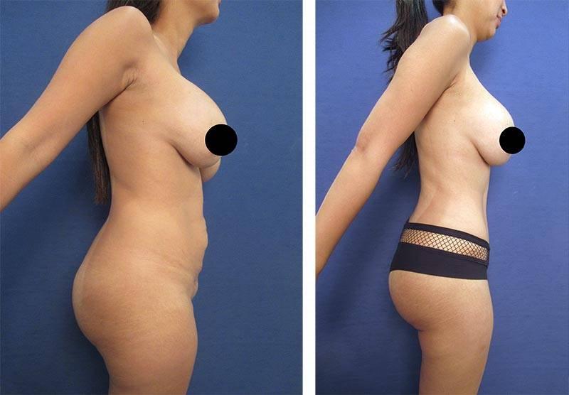 How does implant size affect bra cup size? How does implant size affect bra cup size?