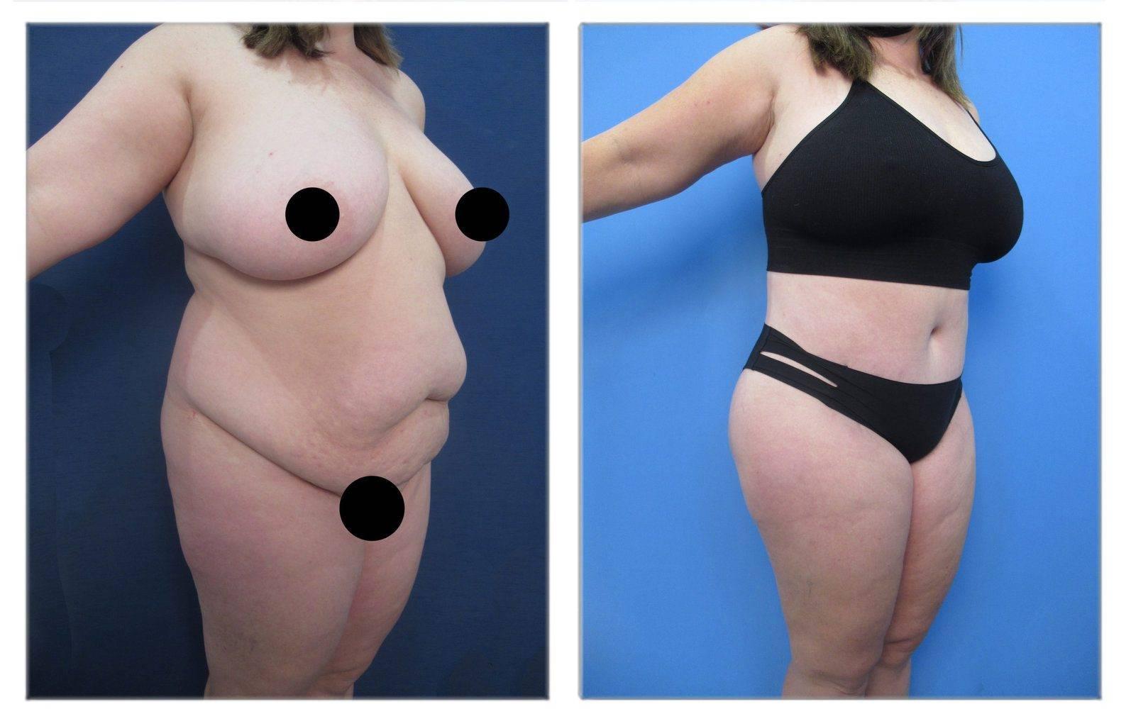 How Does Insulin Resistance Affect Cosmetic Surgery of the Abdomen How Does Insulin Resistance Affect Cosmetic Surgery of the Abdomen