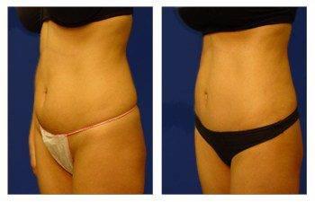 MIni Tummy Tuck MIni Tummy Tuck