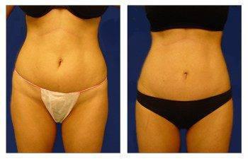 MIni Tummy Tuck MIni Tummy Tuck