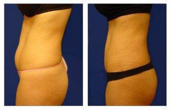 How is a Mini Tummy Tuck Performed How is a Mini Tummy Tuck Performed