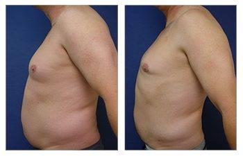 How is Gynecomastia Surgery Performed? How is Gynecomastia Surgery Performed?