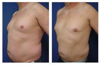 gynecomastia surgery performed gynecomastia surgery performed