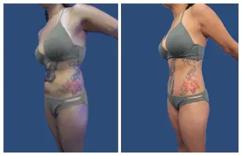 Liposuction Abdoominal Results. Liposuction Abdoominal Results.