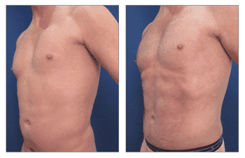 Abdominal Etching Cost - before and after surgery Abdominal Etching Cost - before and after surgery