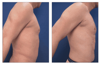 Abdominal Etching Cost - before and after surgery Abdominal Etching Cost - before and after surgery