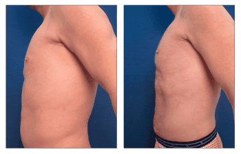 Abdominal Etching Cost - before and after surgery Abdominal Etching Cost - before and after surgery