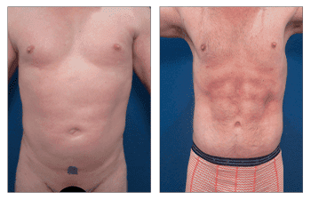 How Much Does Abdominal Etching Cost? How Much Does Abdominal Etching Cost?