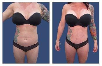 Mini Tummy Tuck Cost