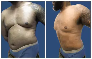 Liposuction Abdoominal Results Liposuction Abdoominal Results