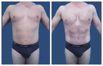 HD Lipo 360 — #SS099 HD Lipo 360 — #SS099