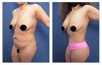 high definition body contouring high definition body contouring