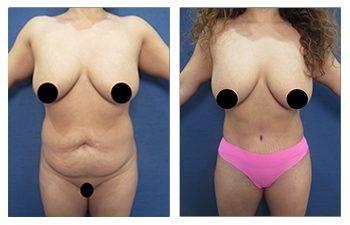 high definition body contouring high definition body contouring