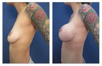 A woman with tattoos before and after breast augmentation, showcasing her ideal breast implants. A woman with tattoos before and after breast augmentation, showcasing her ideal breast implants.