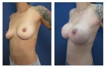A comparison of a woman's breast before and after breast implants. A comparison of a woman's breast before and after breast implants.