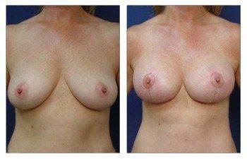 front view How To Get Cleavage With A Breast Lift With Implant Augmentation front view How To Get Cleavage With A Breast Lift With Implant Augmentation
