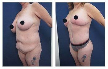 How To Get Rid of FUPA How To Get Rid of FUPA