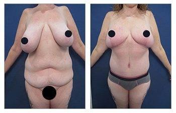 How To Get Rid of FUPA How To Get Rid of FUPA