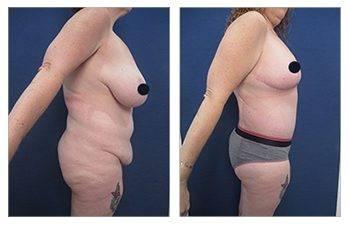 How To Get Rid of FUPA How To Get Rid of FUPA