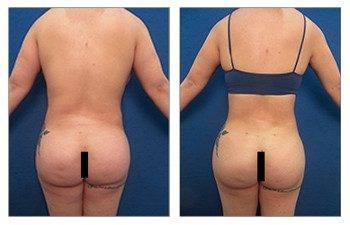 Before and after pictures showcasing the transformation of a woman's butt following a Brazilian Butt Lift (BBL). Before and after pictures showcasing the transformation of a woman's butt following a Brazilian Butt Lift (BBL).