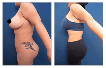 How will my butt look like in clothes after BBL How will my butt look like in clothes after BBL