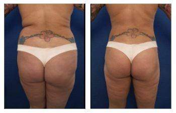 HD Liposuction + BBL — #SS046 HD Liposuction + BBL — #SS046