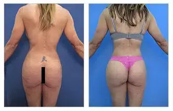 Before and after photos of a tummy tuck procedure. Before and after photos of a tummy tuck procedure.