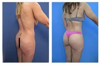 Before and after photos of a tummy tuck in California. Before and after photos of a tummy tuck in California.