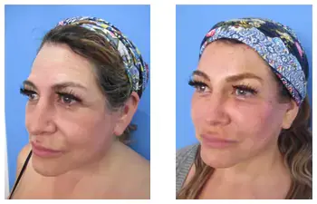 Attiva Radiofrequency Skin Treatment Before And After Attiva Radiofrequency Skin Treatment Before And After