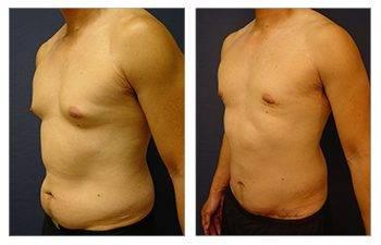 gynecomastia surgery worth it gynecomastia surgery worth it