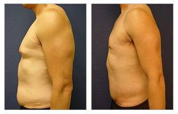 gynecomastia surgery worth it gynecomastia surgery worth it
