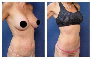 MIni Tummy Tuck MIni Tummy Tuck