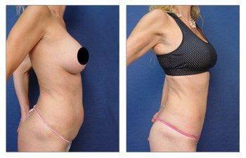 MIni Tummy Tuck MIni Tummy Tuck