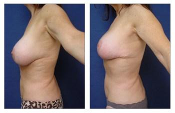 Breast Augmentation Revision of Aged Implants before and after — view 4