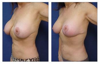 Breast Augmentation Revision of Aged Implants before and after — view 2