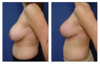 Breast Augmentation Revision + Breast Lift before and after — view 4