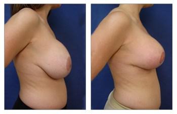 Breast Augmentation Revision + Breast Lift before and after — view 2