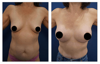 Breast Lift with Implants before and after — view 5